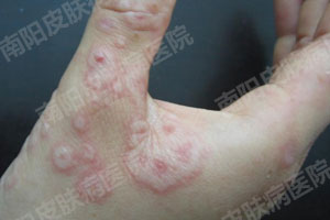 皮肤过敏是什么原因造成的?(图2) 皮肤过敏症状