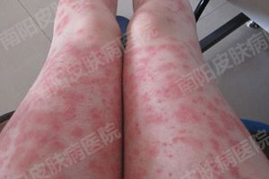 终于摆脱了皮炎——正常生活(图1) 皮炎症状