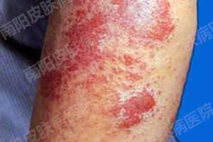 摆脱湿疹“纠缠”——健康生活(图1) 湿疹症状