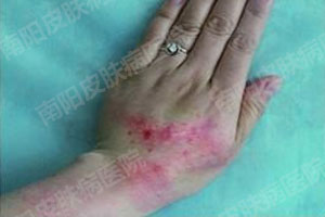 荨麻疹治好了——患者恢复自信(图1) 手部荨麻疹症状