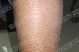 得了鱼鳞病会遗传吗?(图2) 鱼鳞病症状