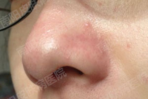 患上酒糟鼻有多大的危害?(图4) 酒糟鼻康复