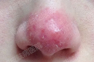 患上酒糟鼻有多大的危害?(图2) 酒糟鼻症状