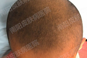 头癣应该怎样预防(图3) 头癣治好