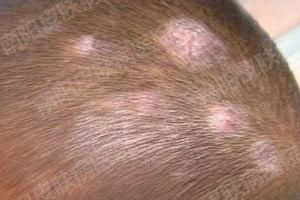 头癣应该怎样预防(图1) 头癣应该怎样预防(图1)