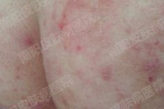 股癣发病原因主要是什么?