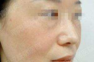 女性黄褐斑有啥危害?(图4) 黄褐斑康复