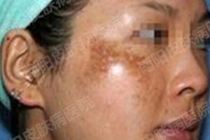 女性黄褐斑有啥危害?(图2) 黄褐斑症状