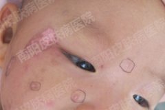 治疗白癜风，还孩子健康