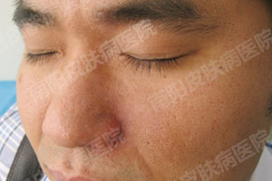 【南阳白癜风医院】白癜风康复患者(图2) 白癜风治好患者