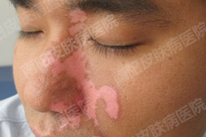 【南阳白癜风医院】白癜风康复患者(图1) 白癜风症状