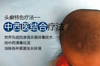 头癣治疗方法