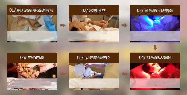 这是什么类型的青春痘 该怎么治(图2)