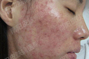 目前常用且有效的祛痘方法(图4)
