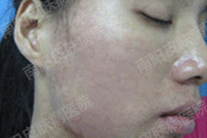 目前常用且有效的祛痘方法(图5)