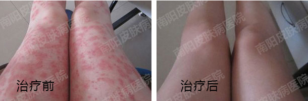 6种常见皮炎症状