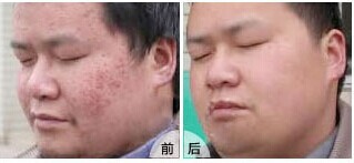 南阳98%的扁平疣患者选择南阳白癜风医院