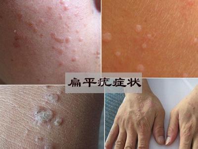 南阳白癜风医院资深去＂疣＂专家揭秘