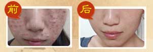 满脸痘痘失去恋爱勇气