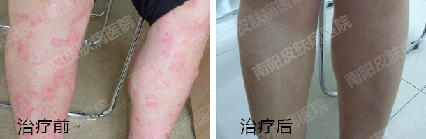 引发牛皮癣的因素有哪些