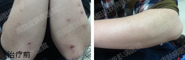了解牛皮癣症状 对症治疗疾病