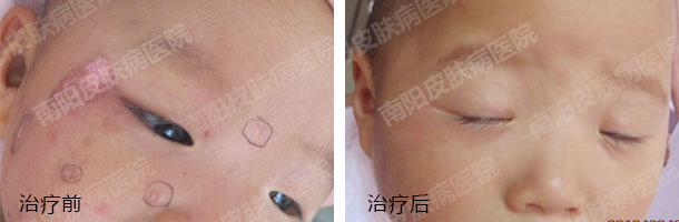 CPPC基因干预分型多维康复工