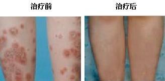 牛皮癣危害大 患者不可小窥