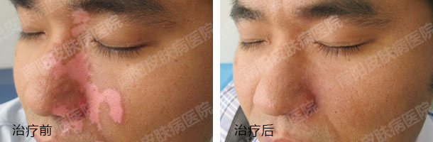 深层解析白癜风病因 合理诊疗是