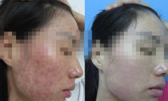 什么是汗斑？
