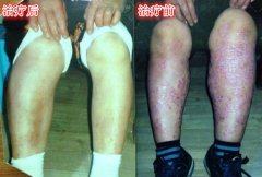 疥疮的病因有哪些？