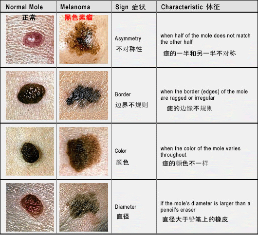 色素痣即黑痣形成的原因？(图2)