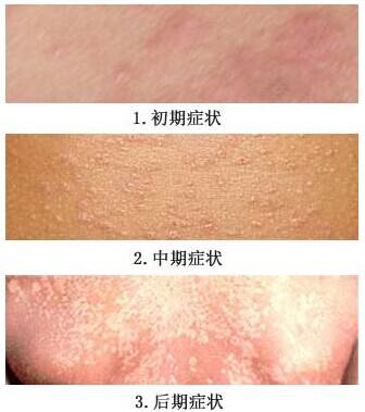 色素性荨麻疹和色素性玫瑰糠疹的区别(图1)