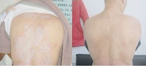 银屑病专业治疗技术,CPPC基因干预分型多维康复(图1) 银屑病专业治疗技术,CPPC基因干预分型多维康复(图1)