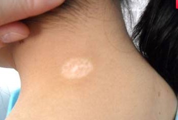 白癜风专业治疗技术,MDR多维双向辨证康复工程(图1) 白癜风专业治疗技术,MDR多维双向辨证康复工程(图1)