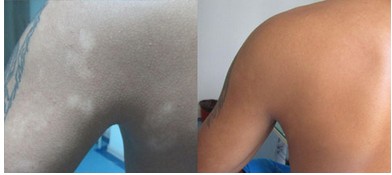 南阳白癜风医院,帮助患者杜绝白斑伤害(图2) 南阳白癜风医院,帮助患者杜绝白斑伤害(图2)