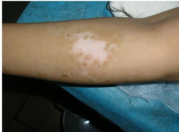 南阳白癜风医院,帮助患者杜绝白斑伤害(图1) 南阳白癜风医院,帮助患者杜绝白斑伤害(图1)