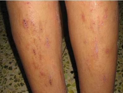 皮肤瘙痒有哪些危害呢(图1) 皮肤瘙痒有哪些危害呢(图1)