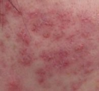 南阳皮肤病研究所，治疗青春痘不反复