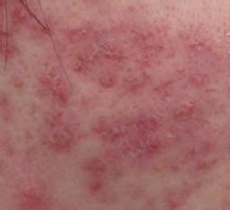 南阳皮肤病研究所,治疗青春痘不反复(图1) 青春痘