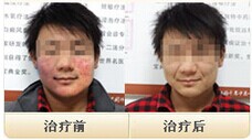 南阳皮肤病研究所,治疗青春痘不反复(图2) 南阳皮肤病研究所,治疗青春痘不反复(图2)