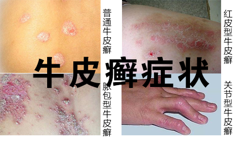 牛皮癣类型及症状(图1) 南阳皮肤病医院