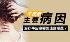 导致牛皮癣发病原因