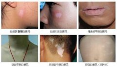 白癜风症状有哪些