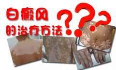 白癜风治疗方法有哪些