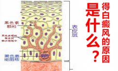 导致白癜风发病原因