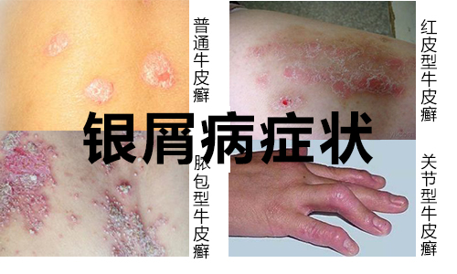 银屑病早期症状有哪些(图1) 南阳皮肤病医院
