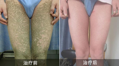 得了鱼鳞病怎么办(图1) 南阳皮肤病医院