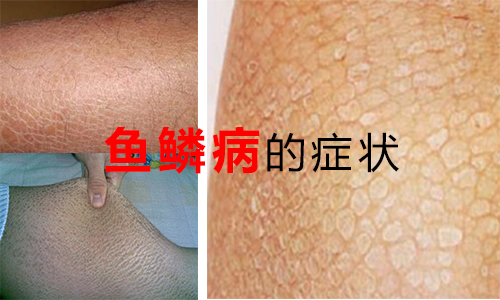 常见鱼鳞病症状有哪些(图1) 南阳皮肤病医院