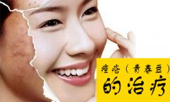 痤疮怎么治疗