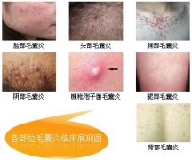 痤疮有哪些症状